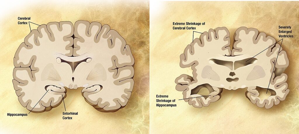 Ilustración que compara un cerebro sano con otro afectado por alzhéimer (imagen de archivo)