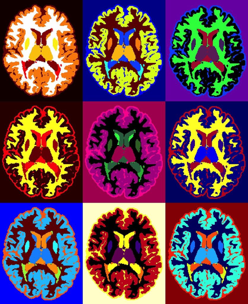 Resonancias magnéticas del cerebro de una persona con esclerosis múltiple