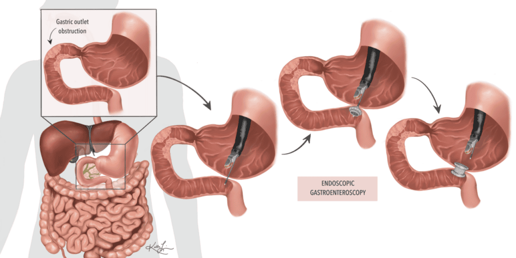 Esquema de una gastroenterostomía guiada por ecoendoscopia