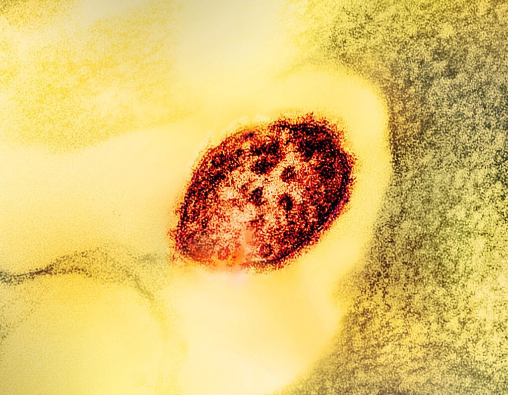 Partícula del virus del sarampión vista al microscopio electrónico